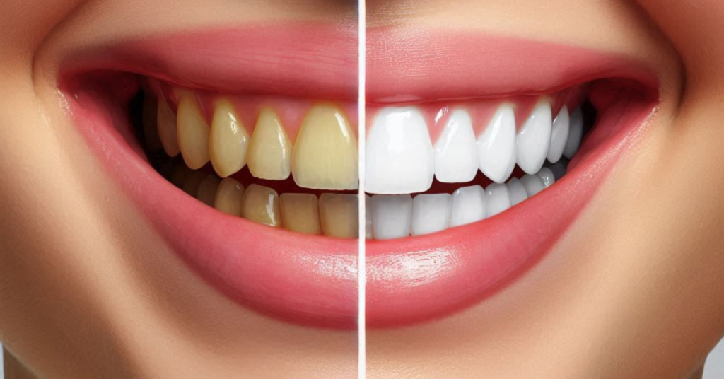 The Benefits of Teeth Whitening: Achieve a Brighter Smile