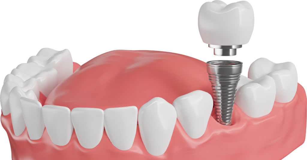 Caring for your dental implants: Tips for long-term maintenance