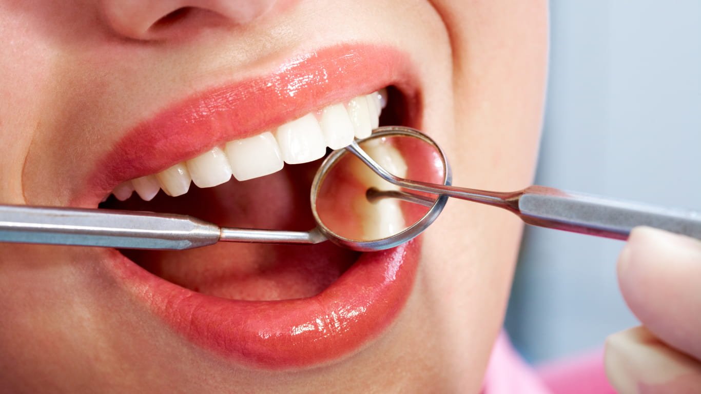 Dental bonding Kottayam