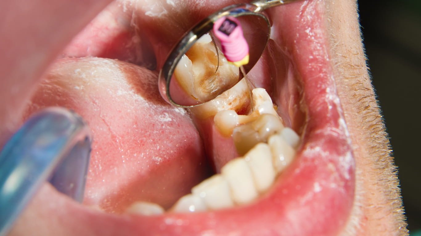 Root canal Kottayam