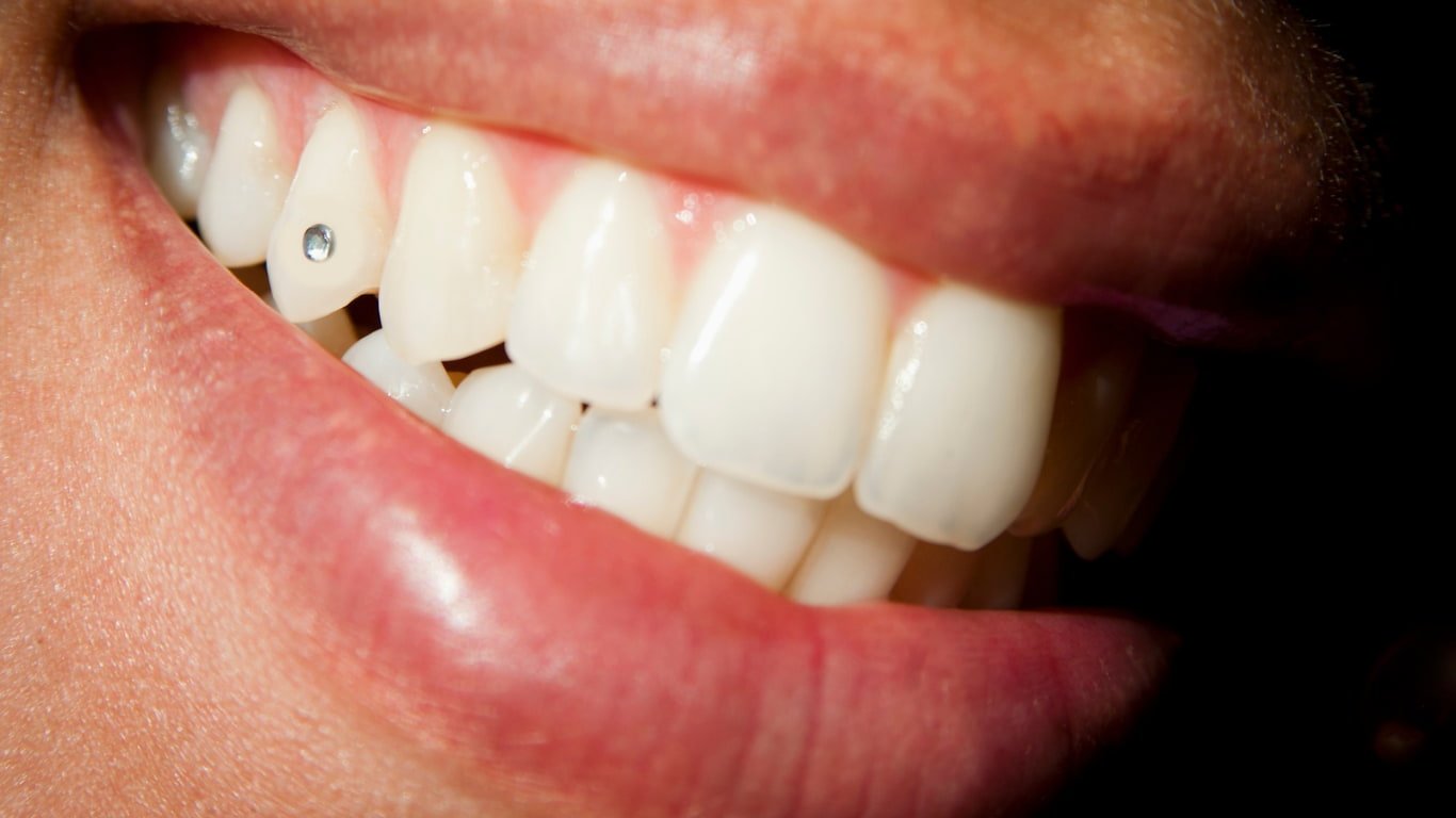 Dental Jewellery Kottayam