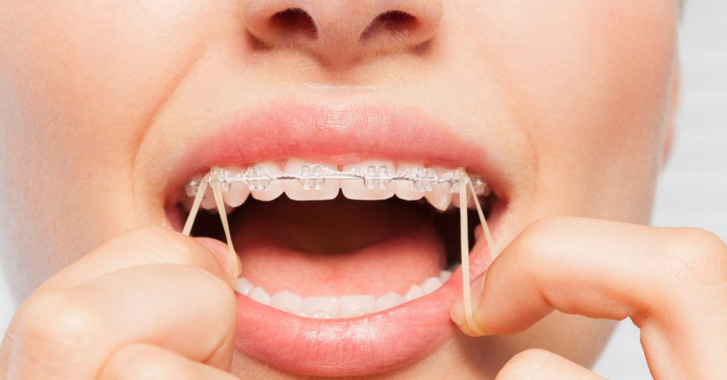 Orthodontics for Adults: It’s Never Too Late for a Perfect Smile.